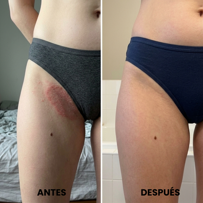 CalmaPiel™. Pliegues sin sarpullido en 1 semana.
