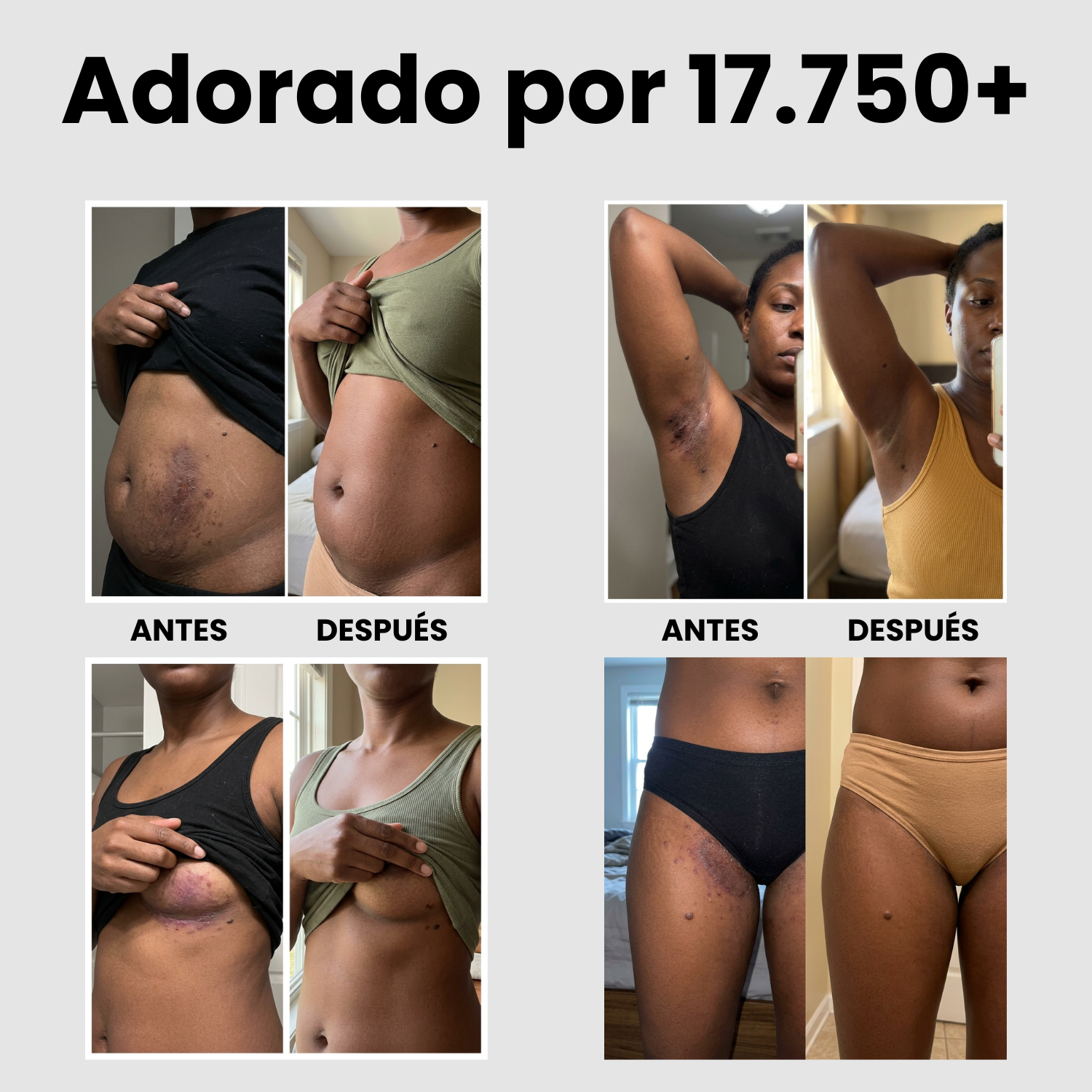 CalmaPiel™. Pliegues sin sarpullido en 1 semana.